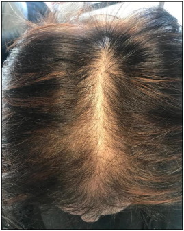 Homeopathic treatment for female pattern hair loss (FPHL) and thinning hair
